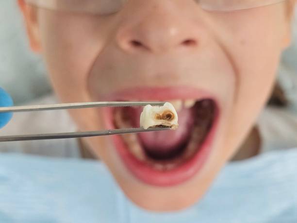 Best Emergency Dentist for Lost Fillings or Crowns in Fairview Shores, FL