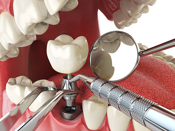 Best Emergency Root Canal Treatment in Fairview Shores, FL